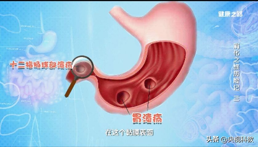 胃溃疡幽门螺杆菌中药治疗,胃溃疡加幽门螺杆菌的详细用药