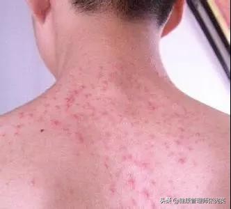 身体长小米粒是什么原因,背后长了很多小米粒