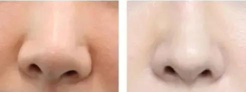 鼻孔不对称最佳解决方法,鼻子一侧通气不流畅鼻孔不对称