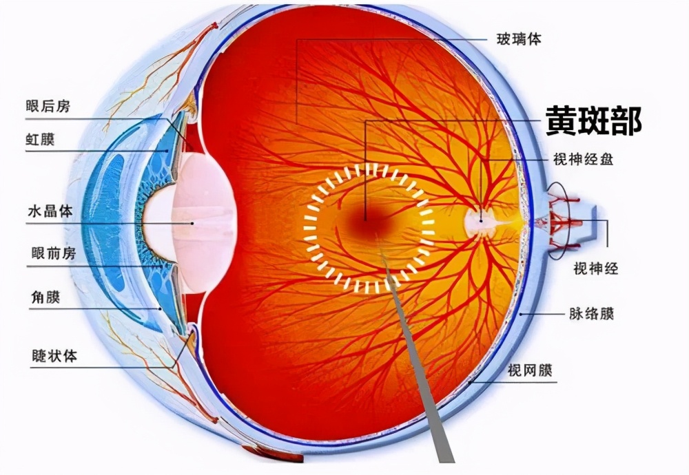 老年人眼睛黄斑变性是什么引起,什么体质的人容易患老年黄斑变性