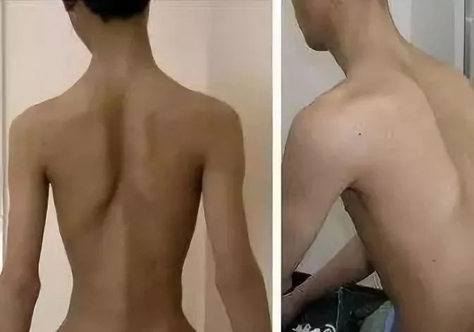 肌肉萎缩能逆转吗,肌肉萎缩神经受损还能恢复吗