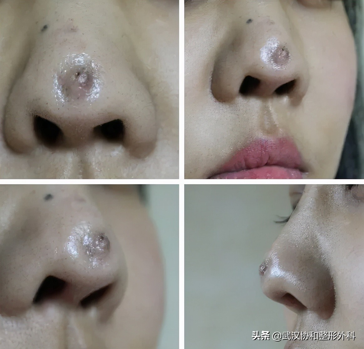 为什么不建议做线雕隆鼻手术,为什么不建议做线雕隆鼻