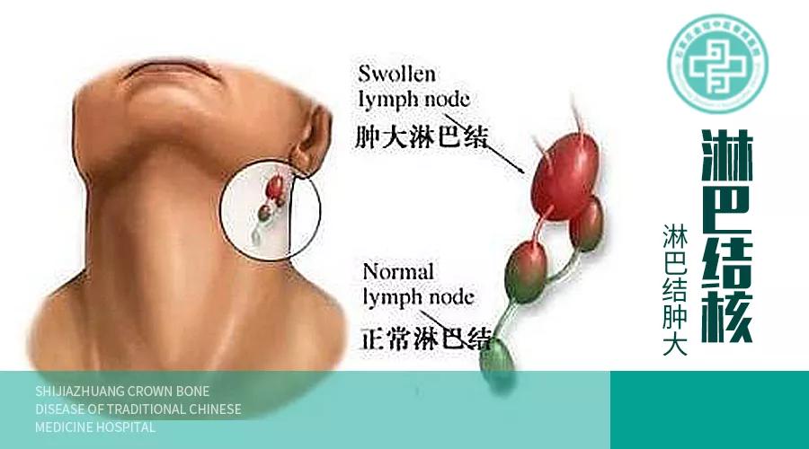 淋巴炎和淋巴结核的区别,淋巴炎和腮腺炎区别
