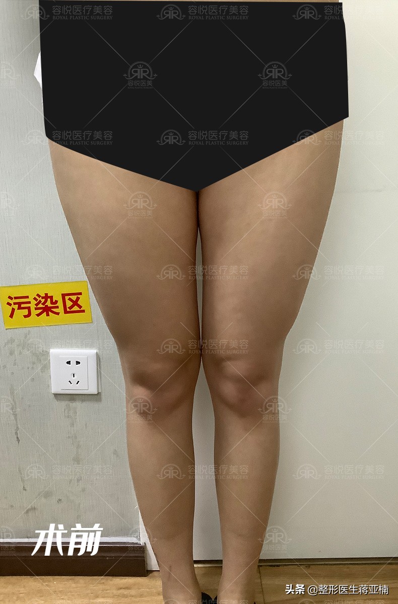 吸脂塑形造就婀娜身材,瘦人美容