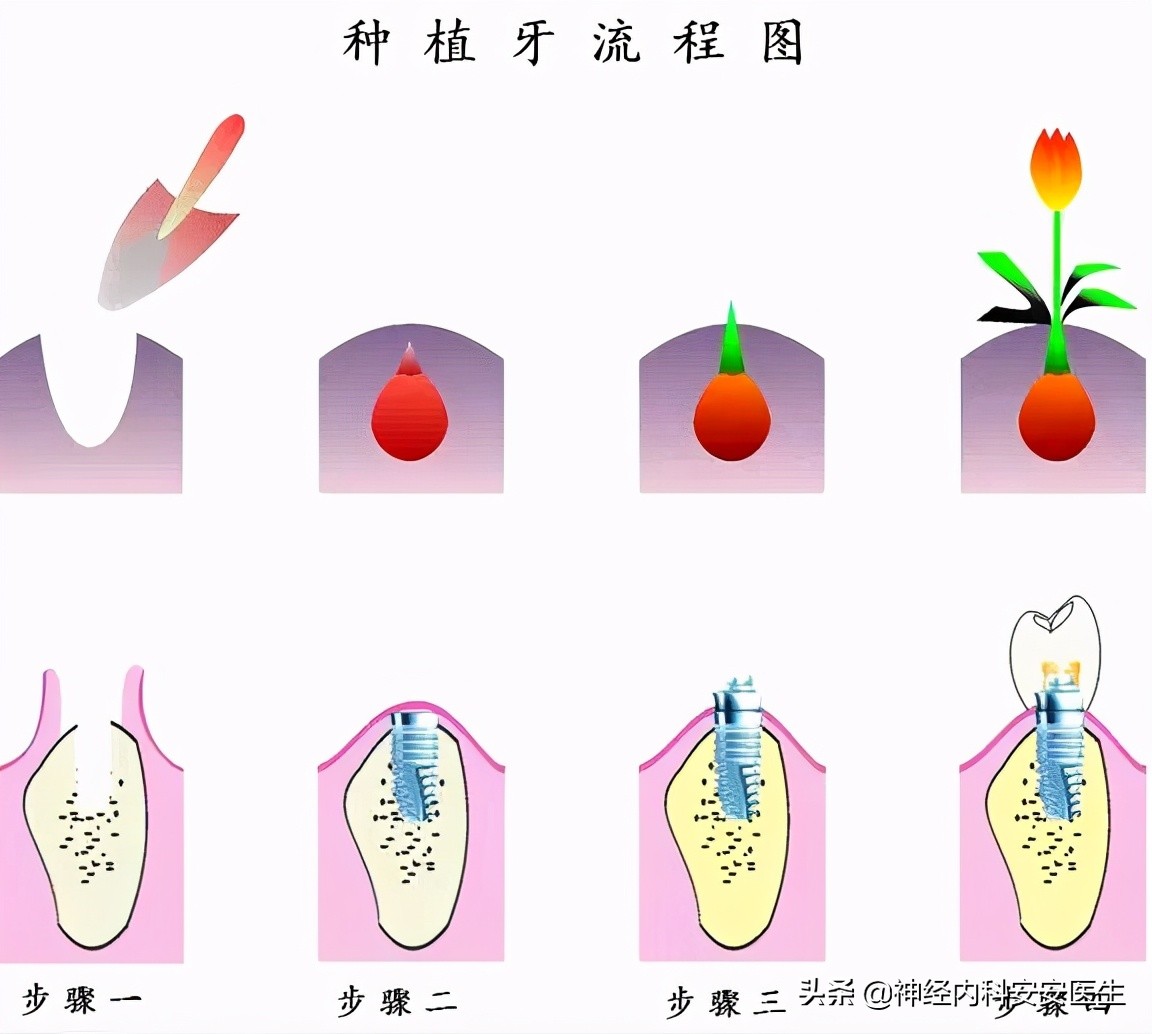 种植牙究竟是怎样的?是播种后再长出新牙齿吗?有哪些优缺点呢?