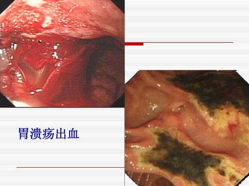 胃镜有治疗作用吗,胃镜有什么用处