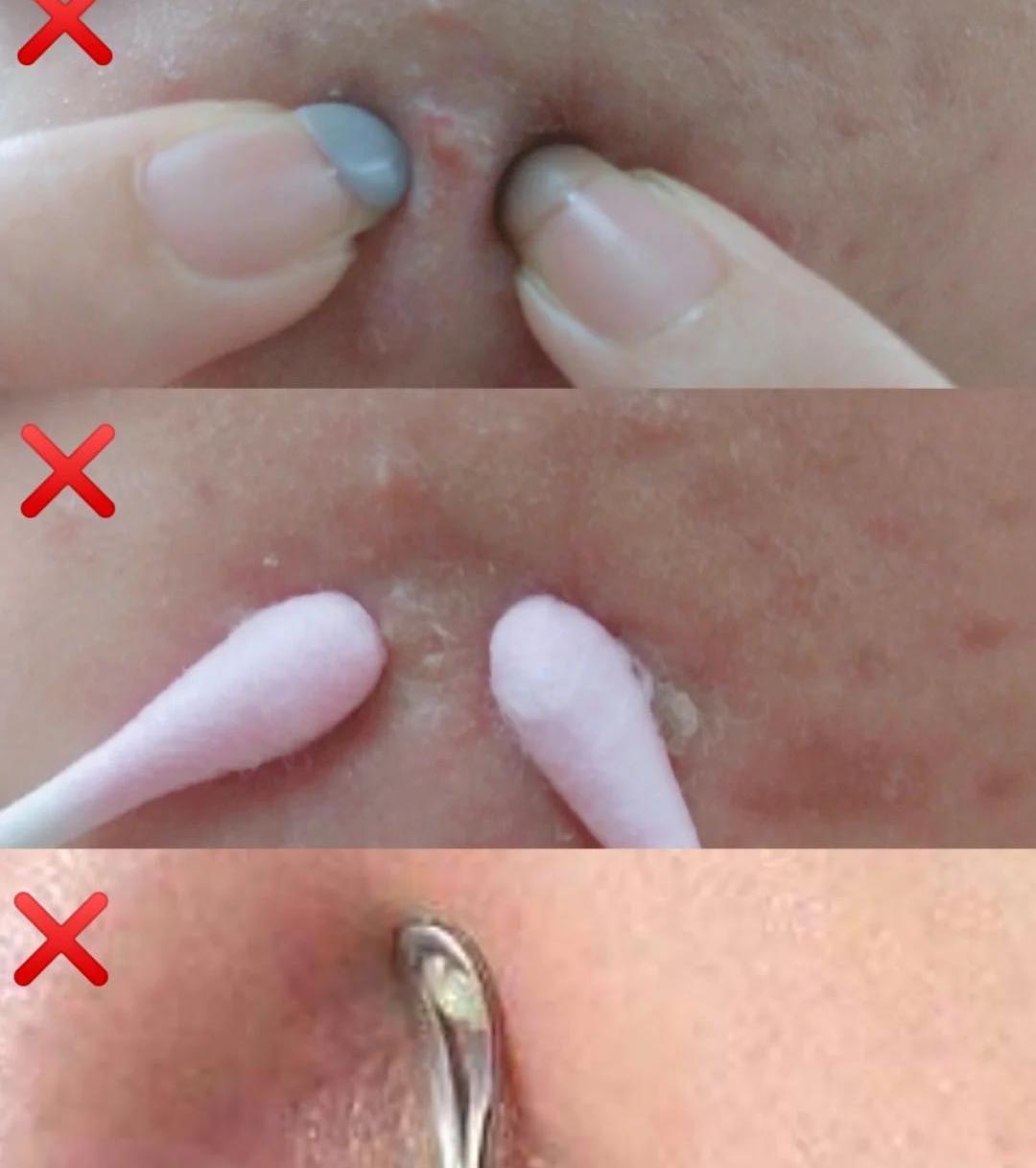 一个长痘女生的十年,女孩长痘的真实经历