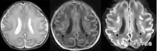 影像学脑室扩大,脑室显大怎么理解