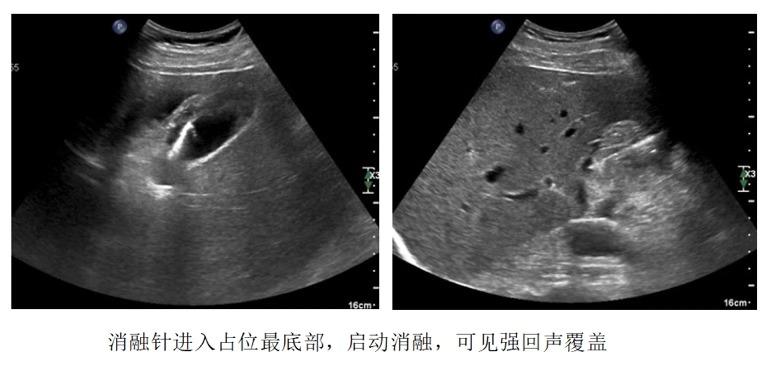 胆囊息肉消融保胆有效吗,胆囊息肉消融保胆有用吗