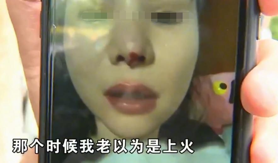 一弯腰就流鼻血？女子吃辣椒打喷嚏爆出“硬物”：我整个人都吓傻了