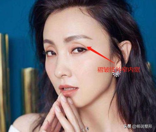 整形医生科普割双眼皮必看攻略,割双眼皮一定好看吗