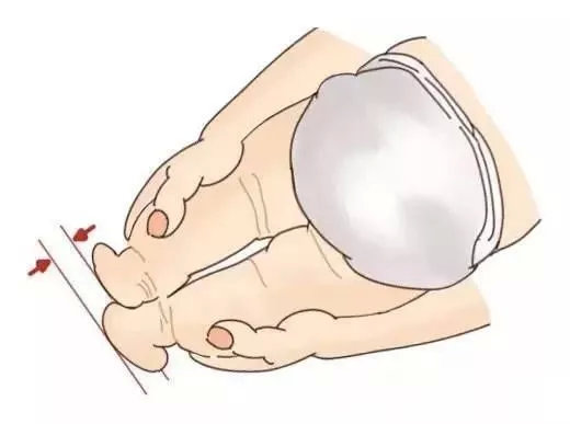 刚出生腿纹正常三个月腿纹不对称,宝宝腿纹轻微不对称怎么解决