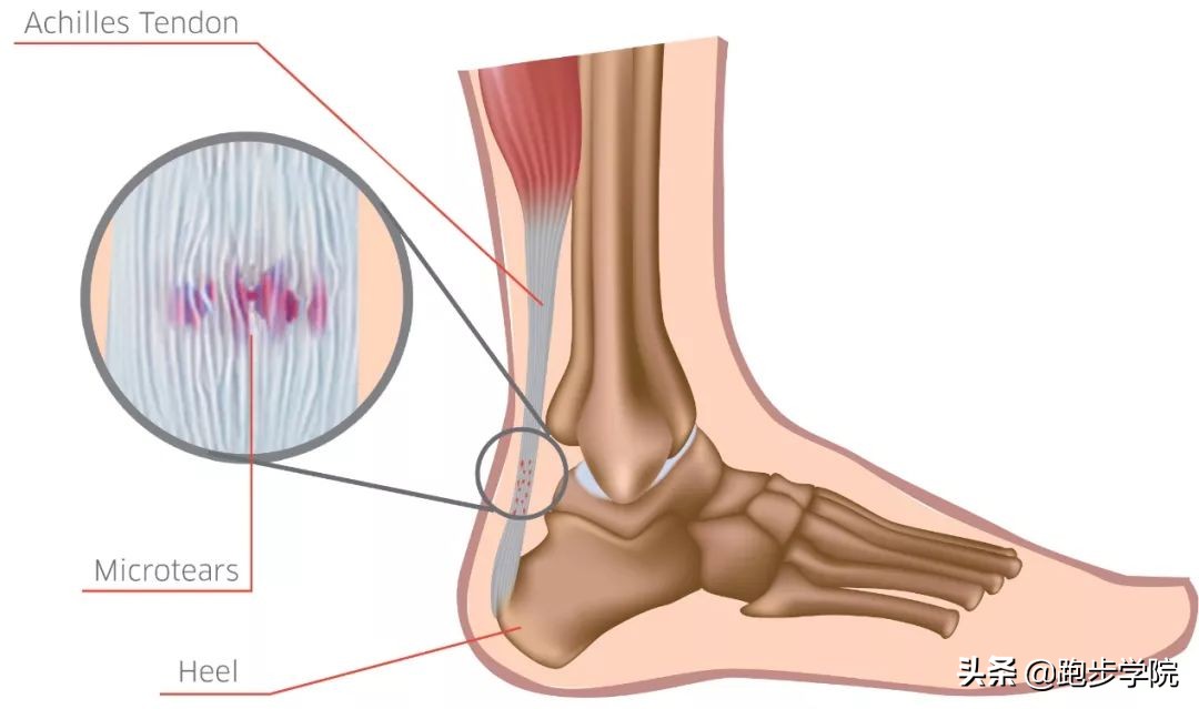 跑步怎样预防跟腱炎,预防跟腱炎最好的方法