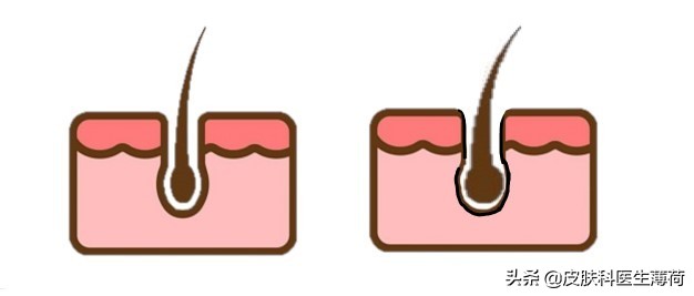 医生清理毛孔,三角区的毛孔粗大该怎么办