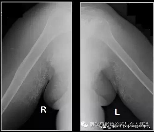 软组织钙化是不是骨化性肌炎,软组织钙化或骨化
