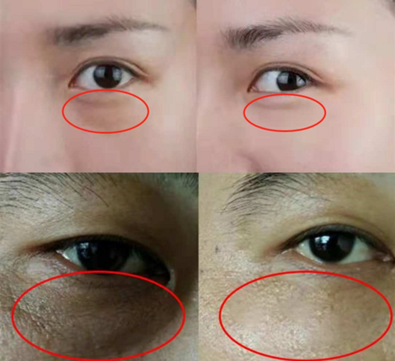 用眼霜快速去除黑眼圈的方法,哪些眼霜可以有效缓解黑眼圈