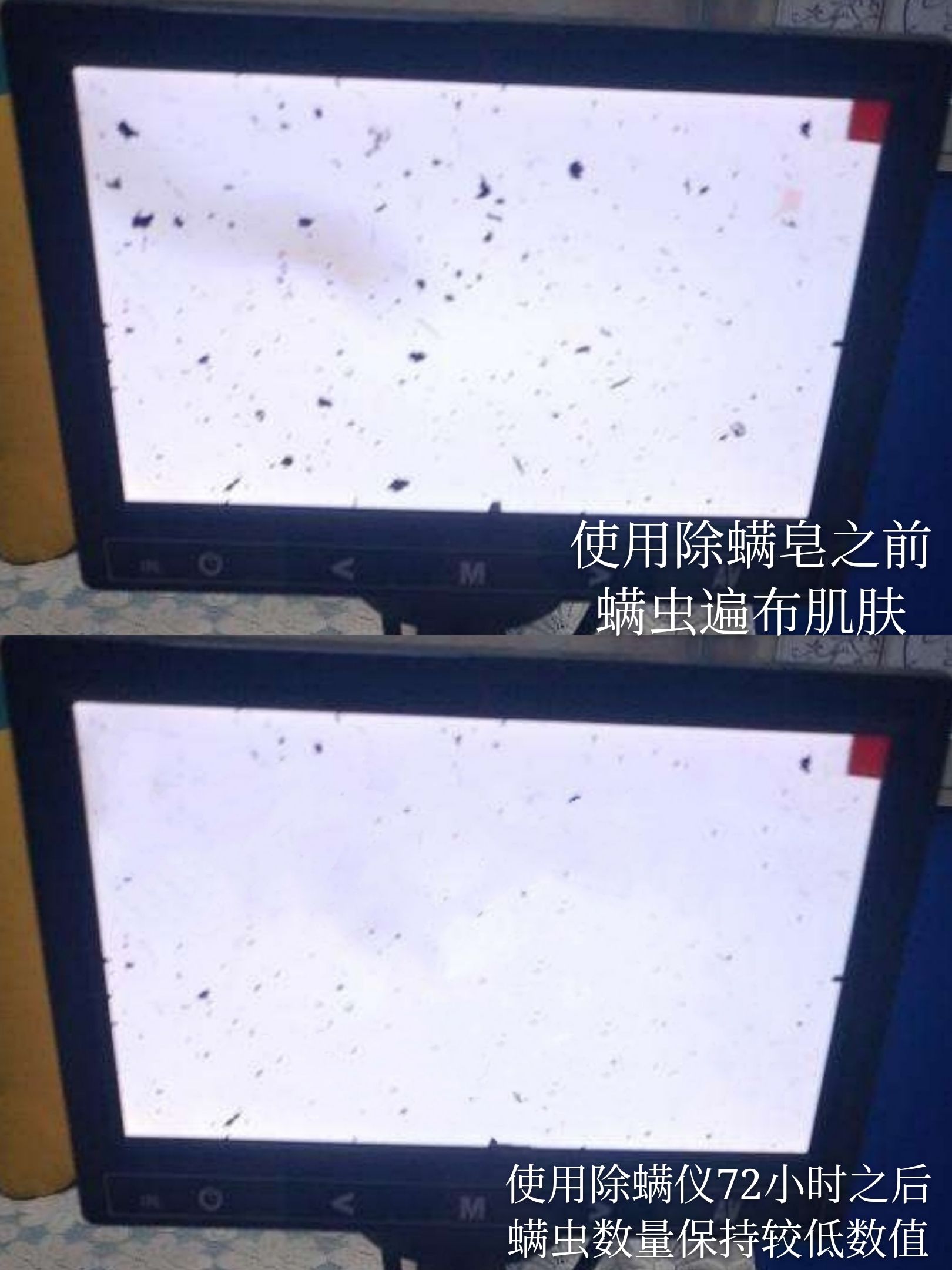 白天身上螨虫多是什么症状,身上螨虫多影响护肤吗