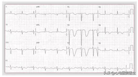 完全性右束支传导阻滞注意什么,完全性右束支传导阻滞如何解决