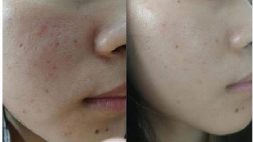 毛孔粗大如何改善三天见效,瘢痕性毛孔粗大解决小窍门