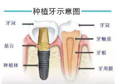 武汉29岁女子整牙掉一半,女人35六岁就开始掉牙了