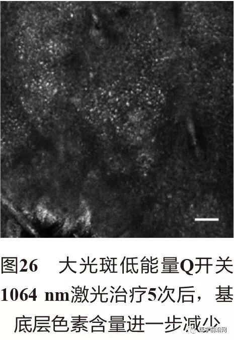 皮肤共聚焦显微镜能查什么,皮肤镜和共聚焦显微镜