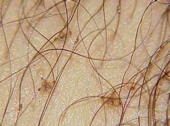 阴虱是什么？洁身自好的人为什么会得阴虱？一般有2个传播途径