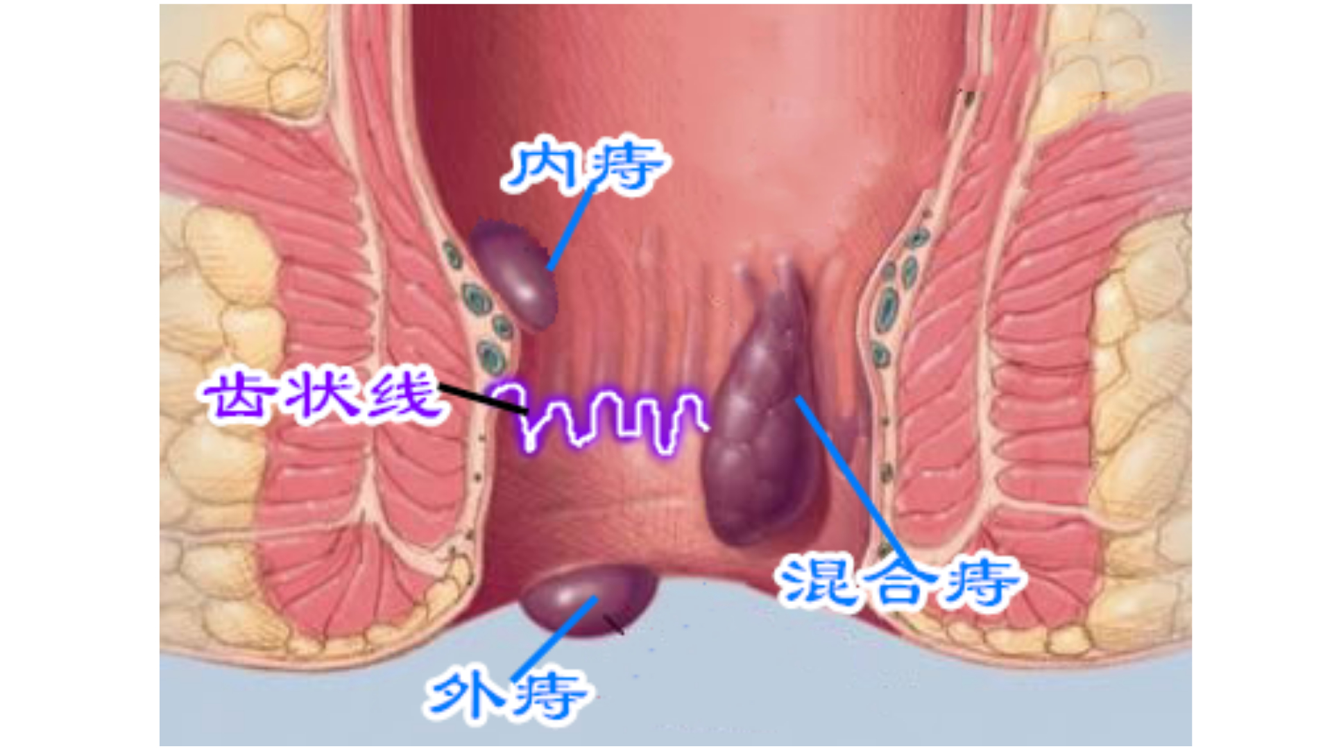 血栓性混合痔疮手术成功率,得了痔疮有内痔外痔手术好不好
