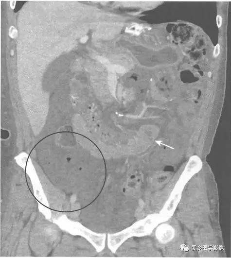 辨识肠梗阻,肠梗阻死亡前兆