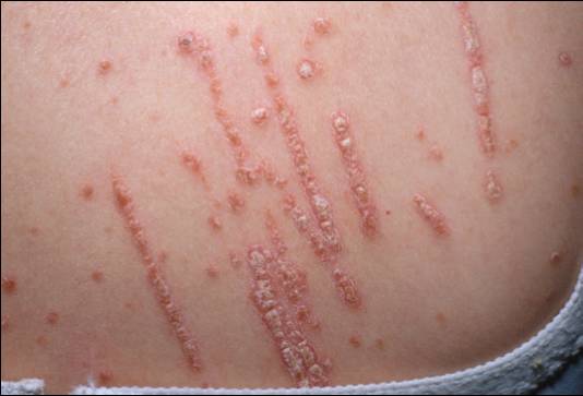 专治牛皮癣银屑病的外用药膏,治疗牛皮癣银屑病民间土方17种