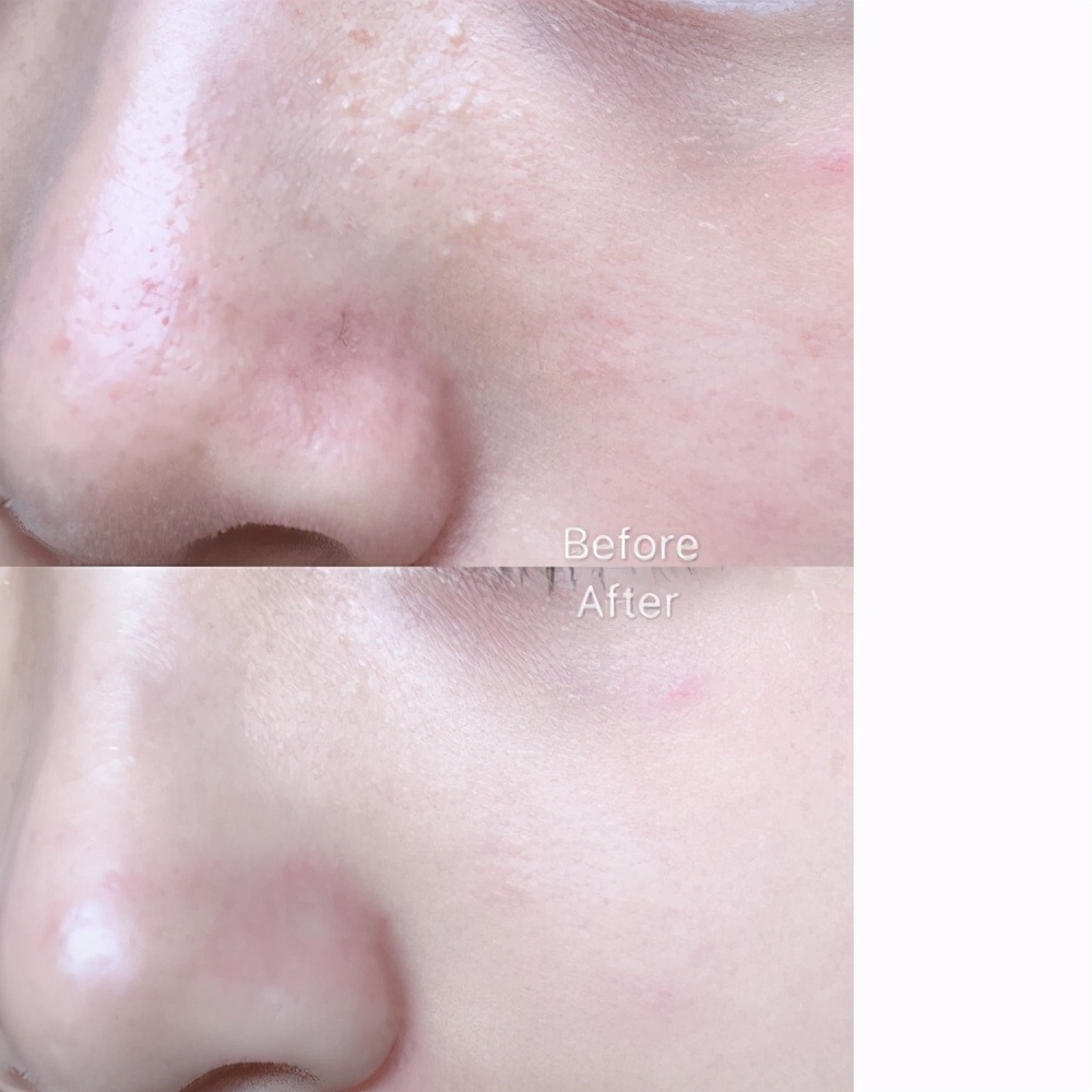 拒绝黑头、毛周角化，每天2块钱轻松搞定💖