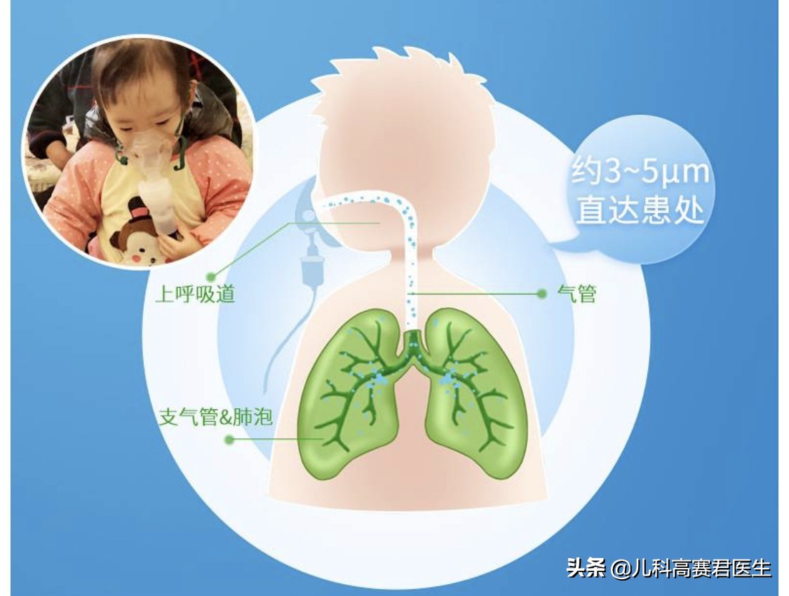 医生为什么喜欢开雾化？需要做吗？儿科医生告诉你真相