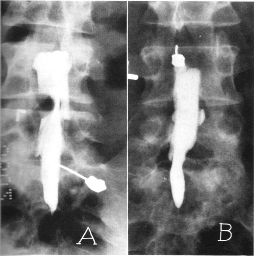 腰椎间盘突出针灸能治彻底吗,腰椎间盘突出针灸治疗能彻底吗