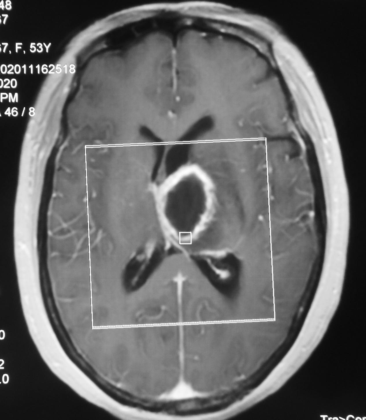 脑脓肿合并脑膜炎需要手术吗,脑脓肿进入左侧脑室严重吗