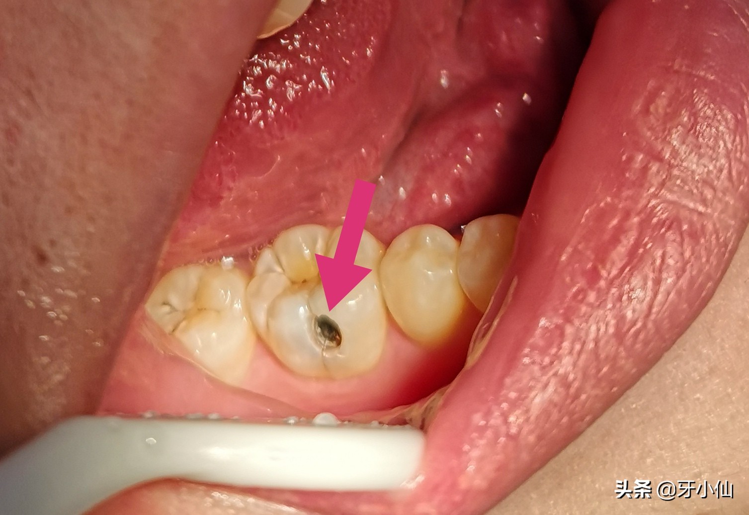 牙太痛，吃不了热辣火锅、冰爽雪糕、酸甜水果，怎么能当吃货？