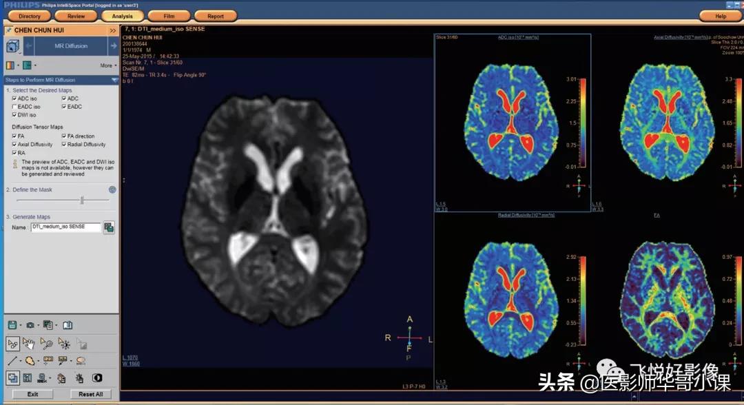 飞利浦磁共振波谱成像扫描技术,飞利浦磁共振纵隔扫描技术
