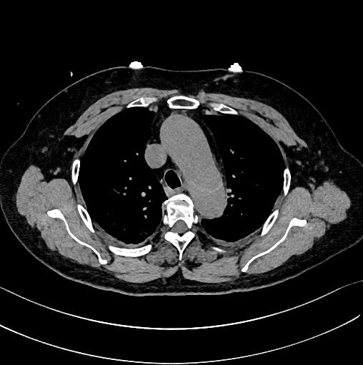 如何监测动脉夹层早期,动脉增强ct能查出主动脉夹层么