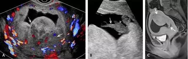 临床上最常见的异常胎盘,前置胎盘和低置胎盘超声