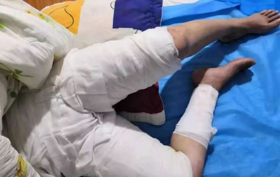 被滚烫的开水烫了,喝滚烫粥被烫伤了怎么办