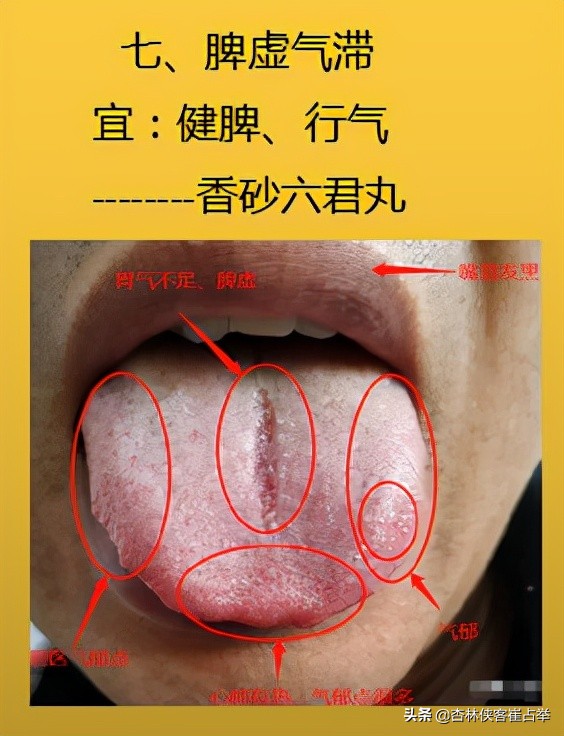 生理性齿痕舌与病理性齿痕舌,齿痕舌形成的原因是脾虚还是瘀血