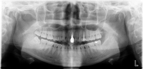 根管治疗和补牙哪个更贵,根管和补牙戴全瓷牙冠一共多少钱