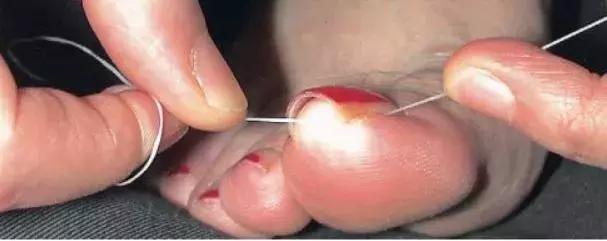 治疗甲沟炎真正有效的办法,甲沟炎指甲剪神器正品