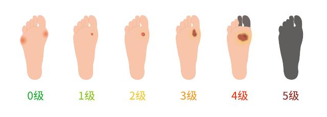 糖尿病足的痛苦,糖尿病足疼痛的不行怎么办