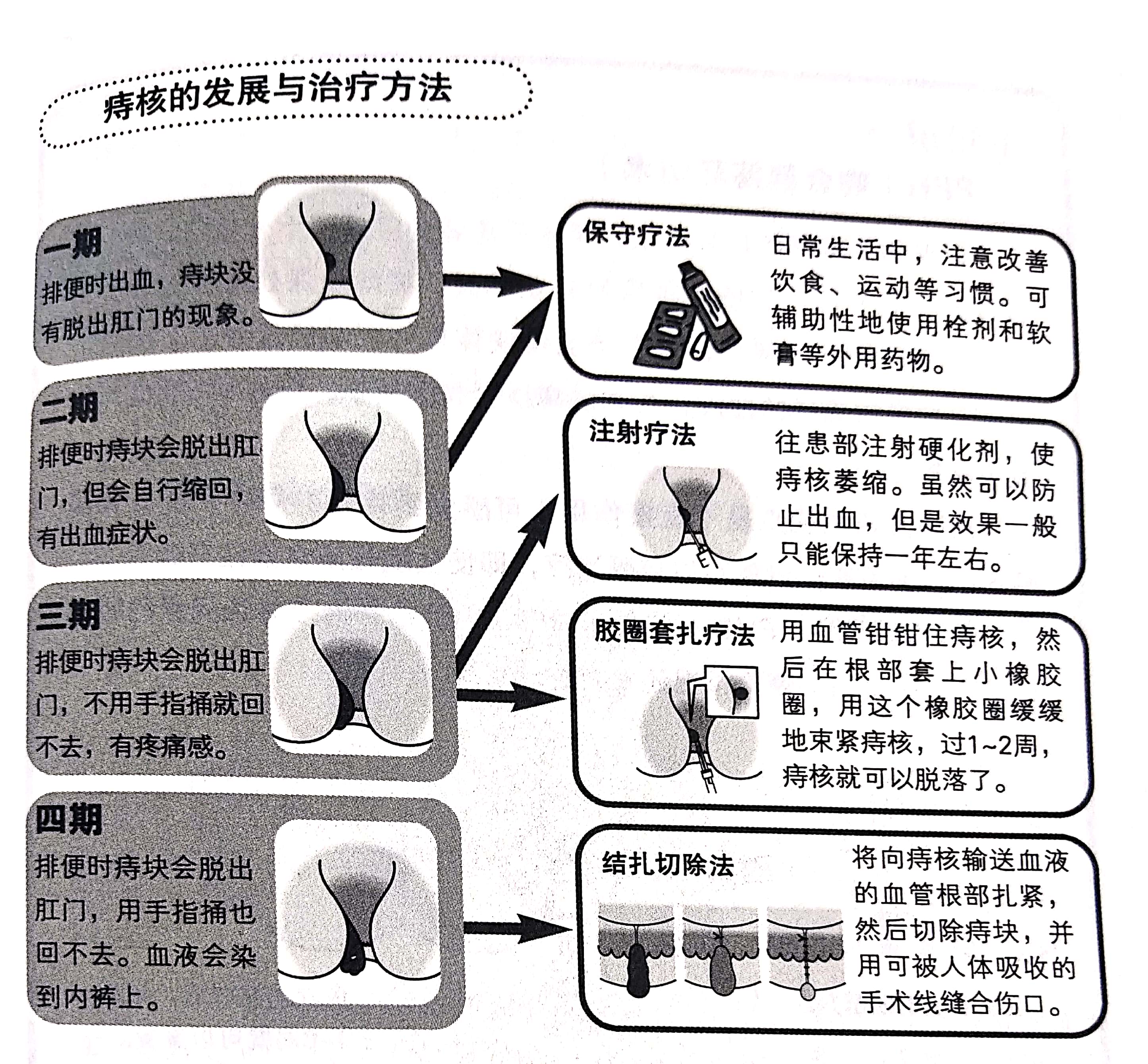 痔疮要怎么治效果才最好,贴肚脐治痔疮