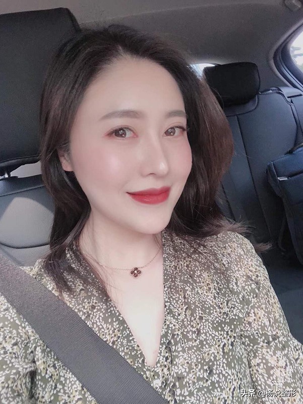 丑小鸭逆袭变天鹅,花3W做鼻整形值不值?术后200天恢复过程分享