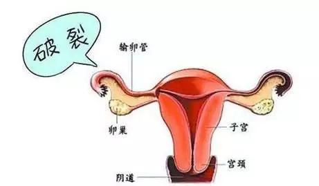 停经、腹痛、阴道流血，你必须想到这个危险