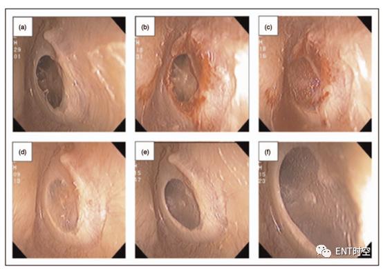 鼓膜再生,耳膜再生复原技术