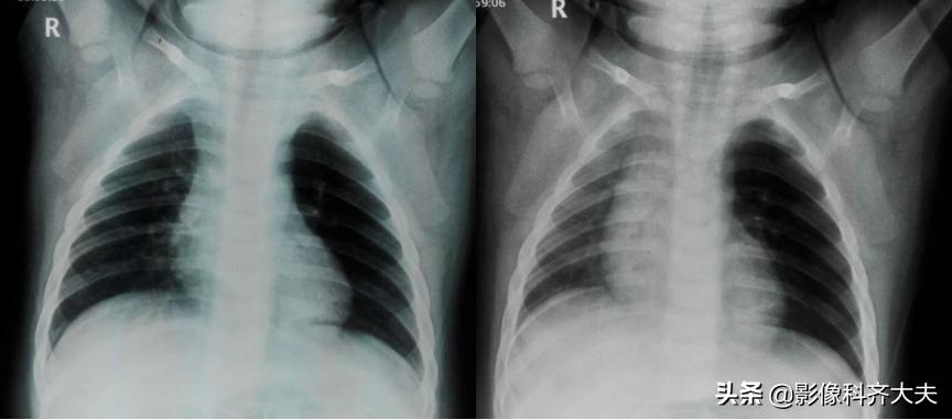 孩子支气管异物ct能查出吗,儿童支气管异物诊断方法