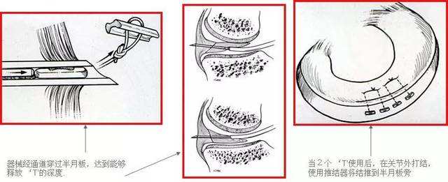 半月板损伤微创手术可以缝合吗,半月板撕裂微创手术缝合线要拆吗