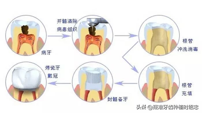 成都牙髓炎根管治疗的医院,牙髓炎必须根管治疗吗视频教程