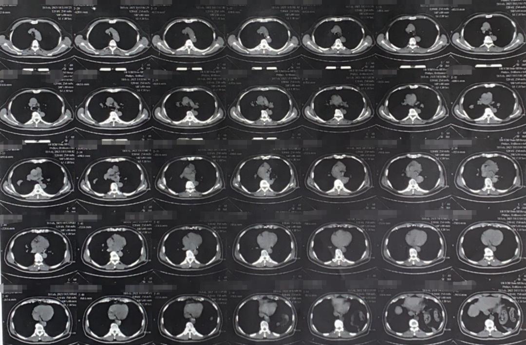 肺部肿块抗炎治疗无变化怎么办,病灶呈轻中度持续强化